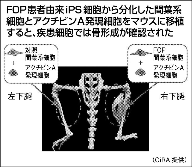 京大など、iPSで筋肉・靭帯の骨化難病の原因物質を特定