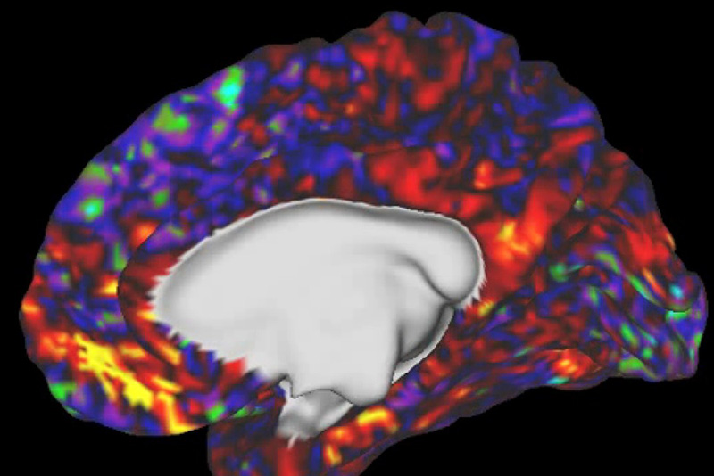 XNef、AIでうつ病診断 脳画像解析、精度向上 | 日刊工業新聞 電子版